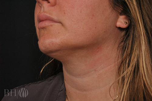 Abdominoplast With Lift Before & After